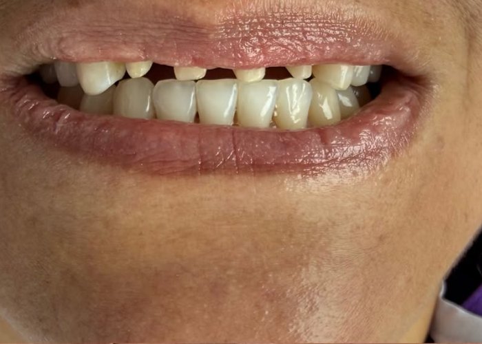 Antes: Diseño de sonrisa en porcelana, paciente de la Dra. Francy López