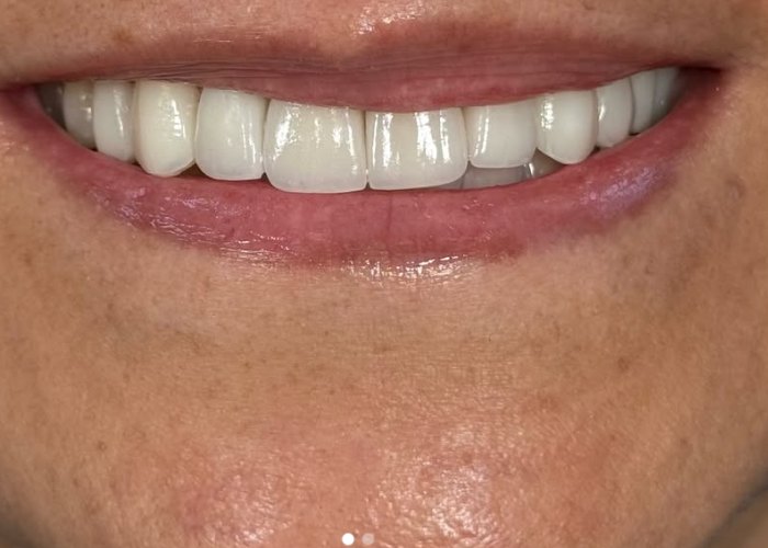 Después: Diseño de sonrisa en porcelana, resultado de la Dra. Francy López en Bogotá