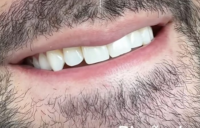Antes: Diseño de sonrisa, paciente de la Dra. Francy López