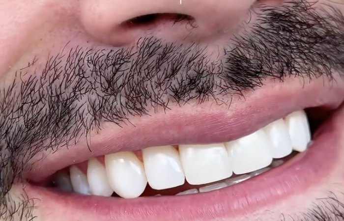 Después: Diseño de sonrisa, resultado de la Dra. Francy López en Bogotá
